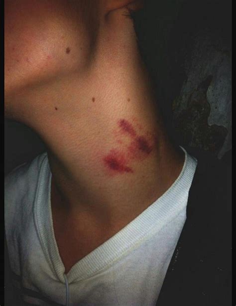 are hickeys dangerous